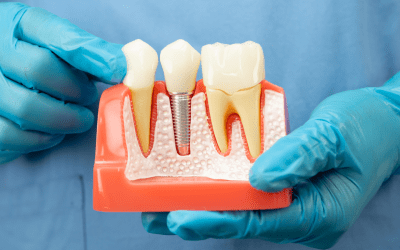Are Dental Implants Worth It in New York City?
