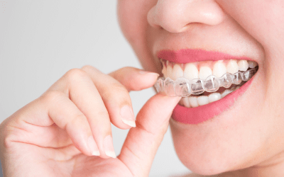 Summer Smile Refresh: Is Now the Right Time for Invisalign?