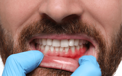 Why You Really Shouldn’t Ignore Those Early Signs of Gum Disease