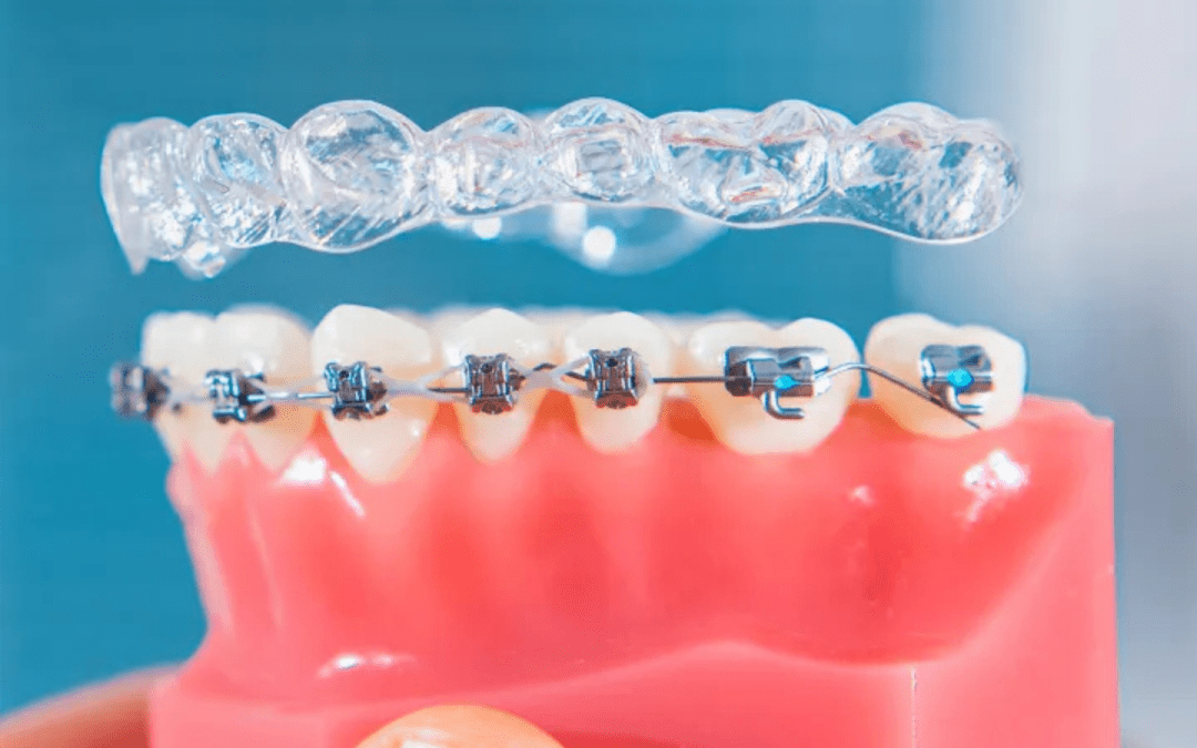 Invisalign vs Traditional Braces: Which Is Right for You?