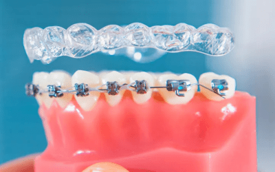Invisalign vs Traditional Braces: Which Is Right for You?