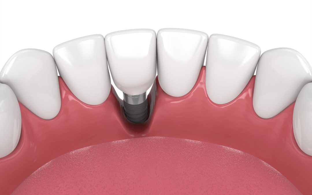 What is peri-implantitis and how do you treat infected dental implants?