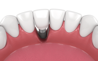 What is peri-implantitis and how do you treat infected dental implants?