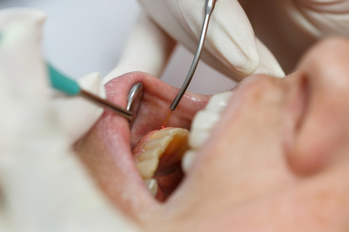 laser gum treatment